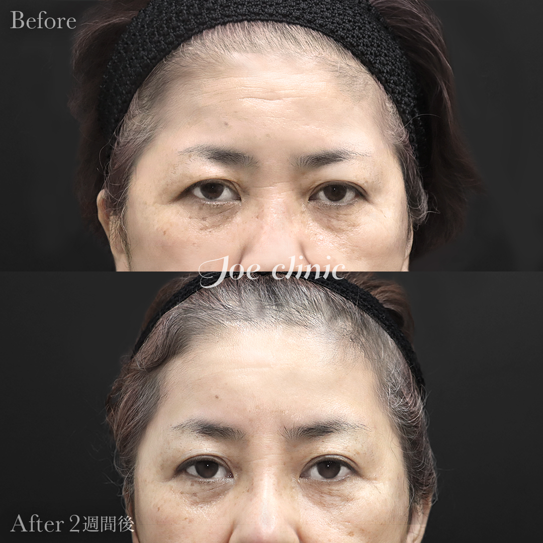 【50代女性】額リフト（内視鏡使用）｜2週間後