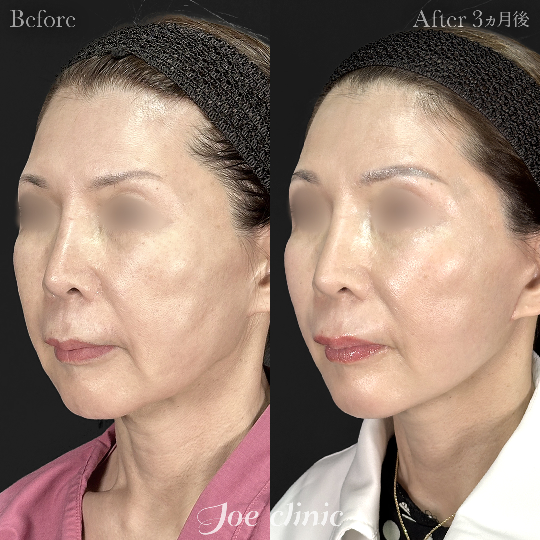 【50代女性】フェイスリフト｜3ヵ月後