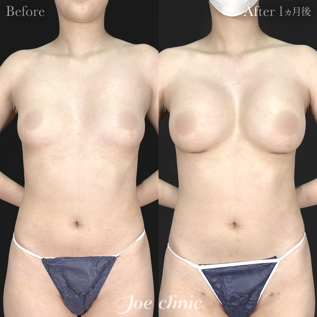 【10代女性】ハイブリッド豊胸 胸下切開 デュアルプレーン法＋脂肪吸引（二の腕）｜1ヵ月後
