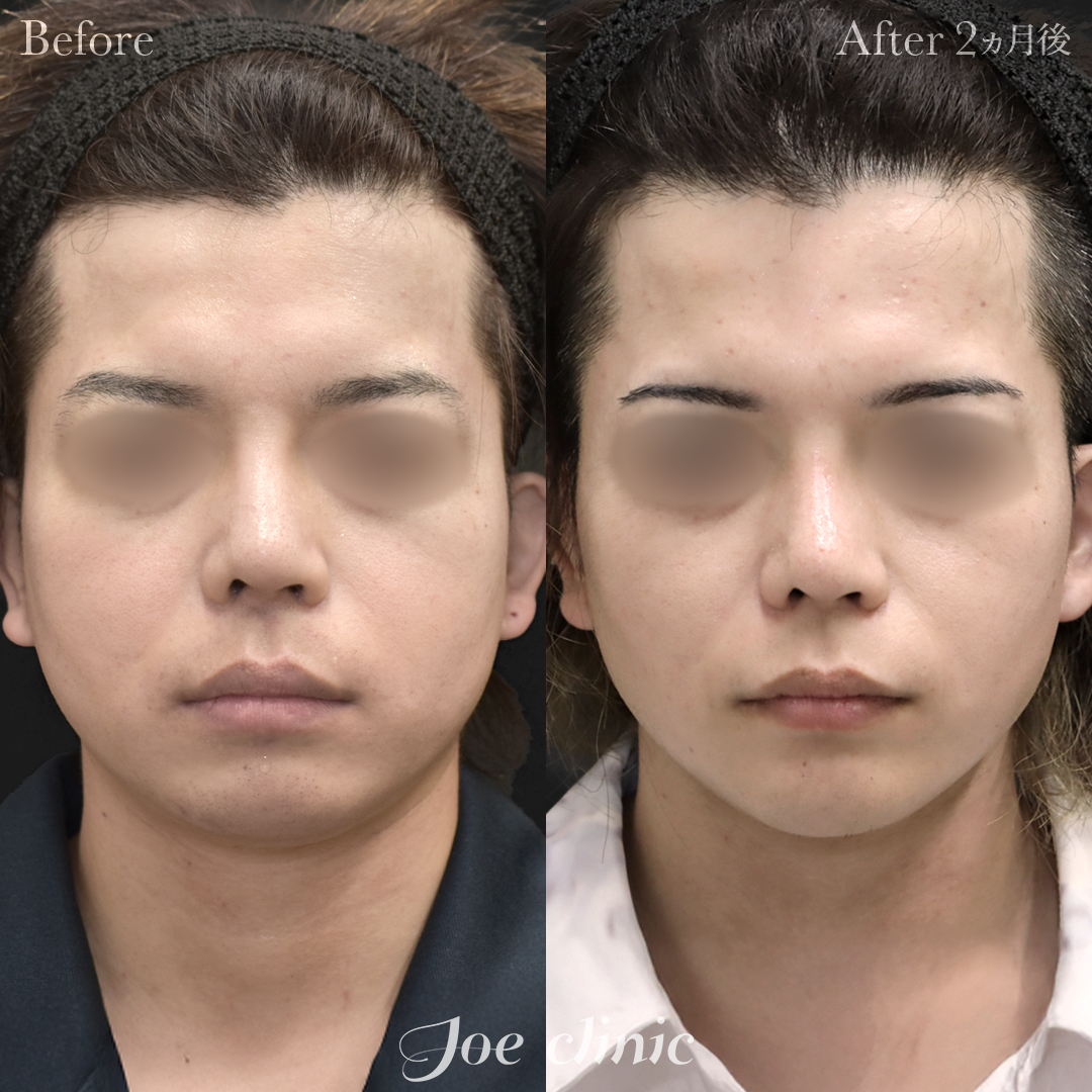 【30代男性】脂肪吸引(頬)+バッカルファット除去+顎プロテーゼ挿入術|2ヵ月後