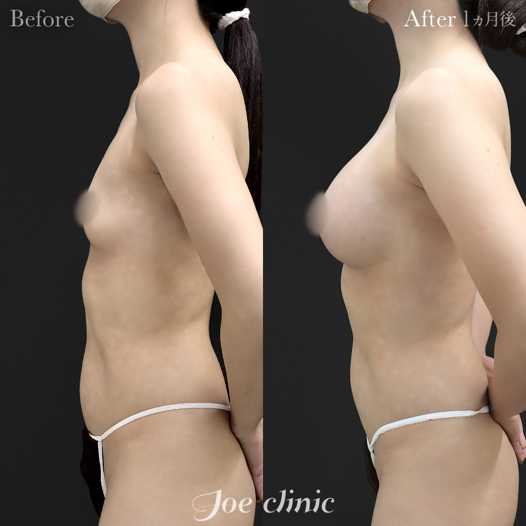 【30代女性】ハイブリッド豊胸(シリコンバッグ豊胸+脂肪幹細胞注入豊胸)|1ヵ月後