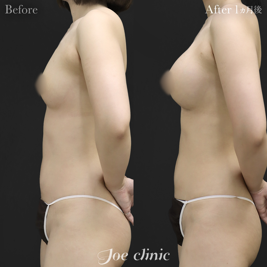 【20代女性】シリコンバッグ豊胸モティバ2(335cc×左右) 胸下切開法|1ヵ月後
