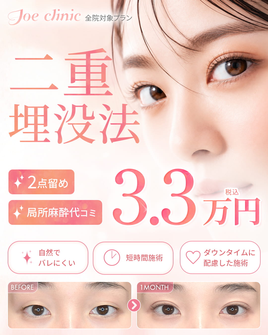 二重埋没法 全院対象プラン