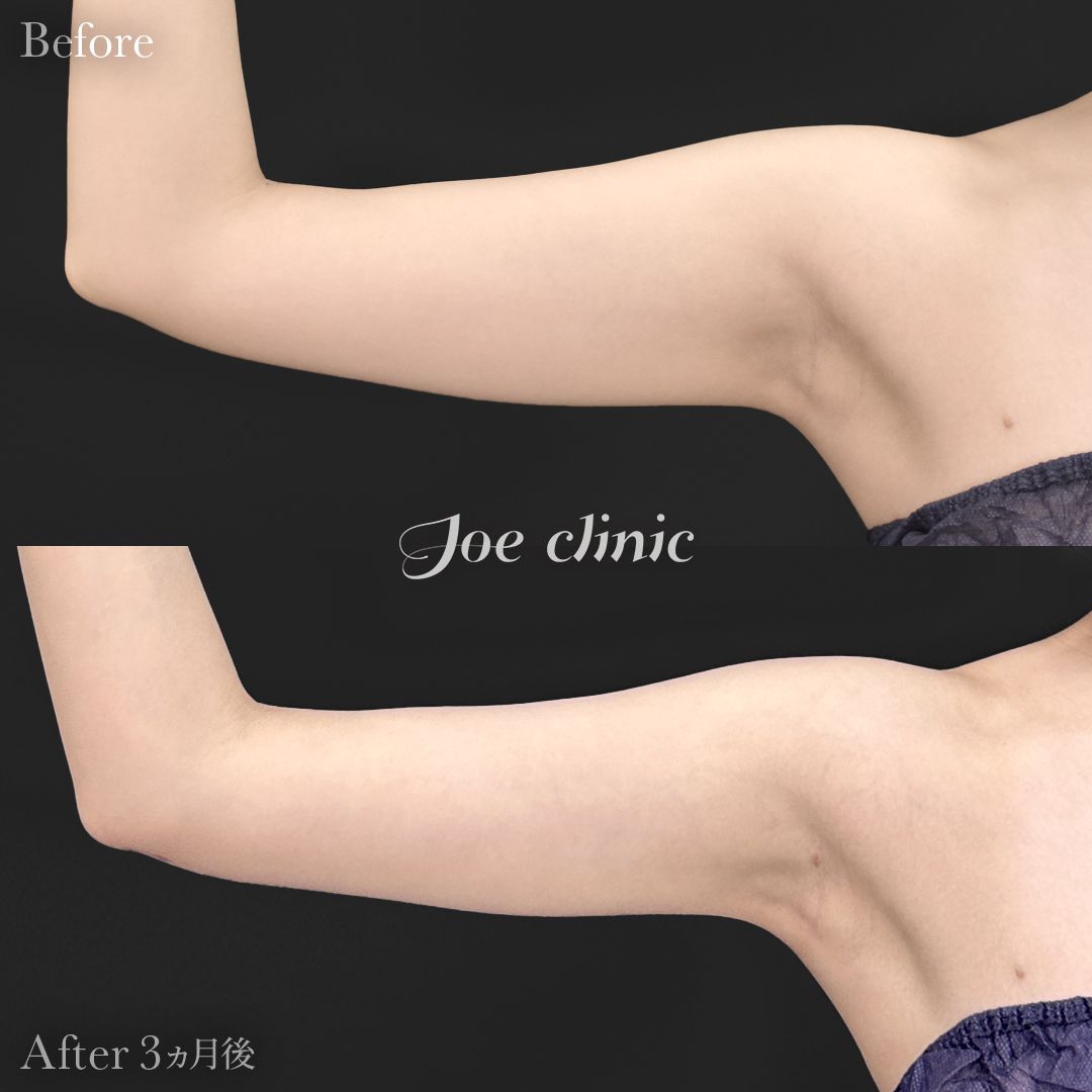 【20代女性】脂肪吸引(フェイスライン・二の腕・肩)+脂肪注入(頬)|3ヵ月後
