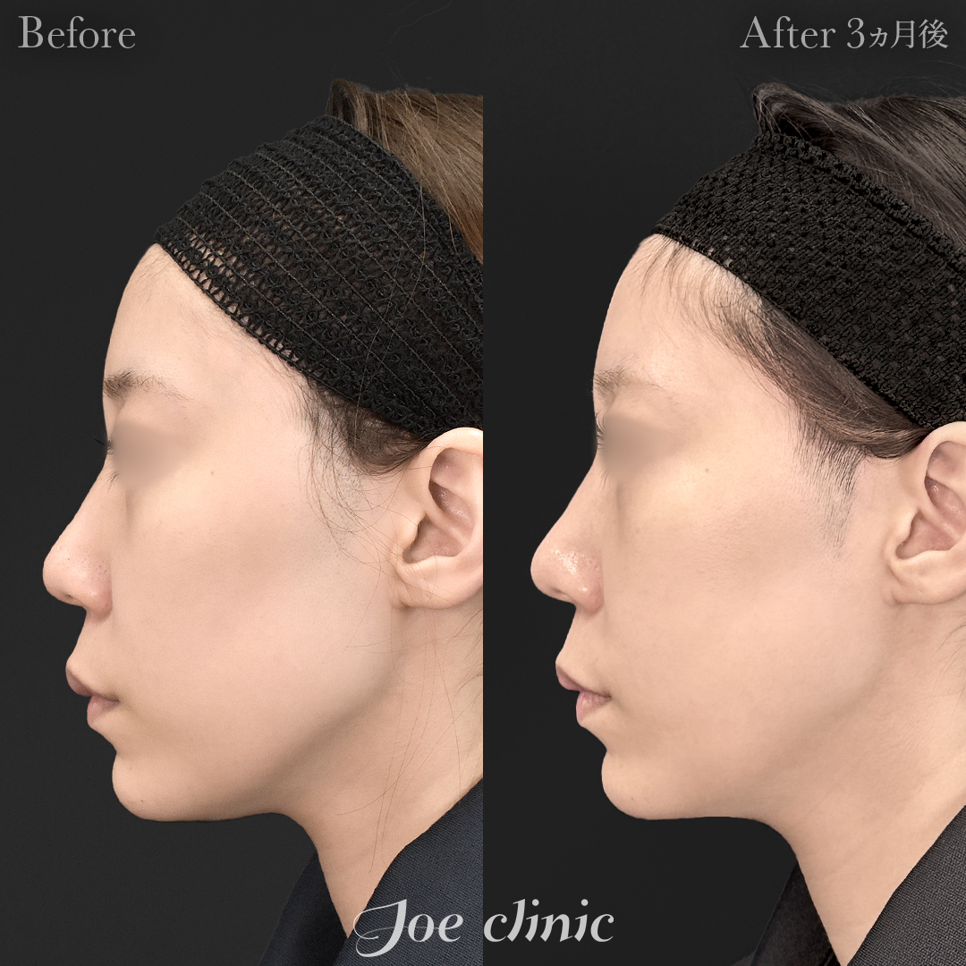 【20代女性】脂肪吸引(フェイスライン・二の腕・肩)+脂肪注入(頬)|3ヵ月後