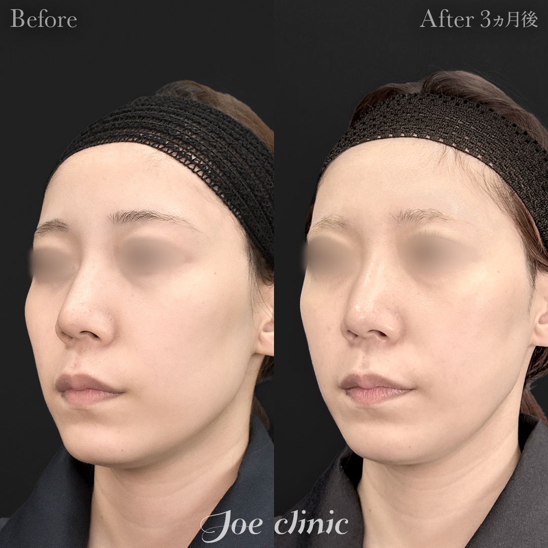 【20代女性】脂肪吸引(フェイスライン・二の腕・肩)+脂肪注入(頬)|3ヵ月後
