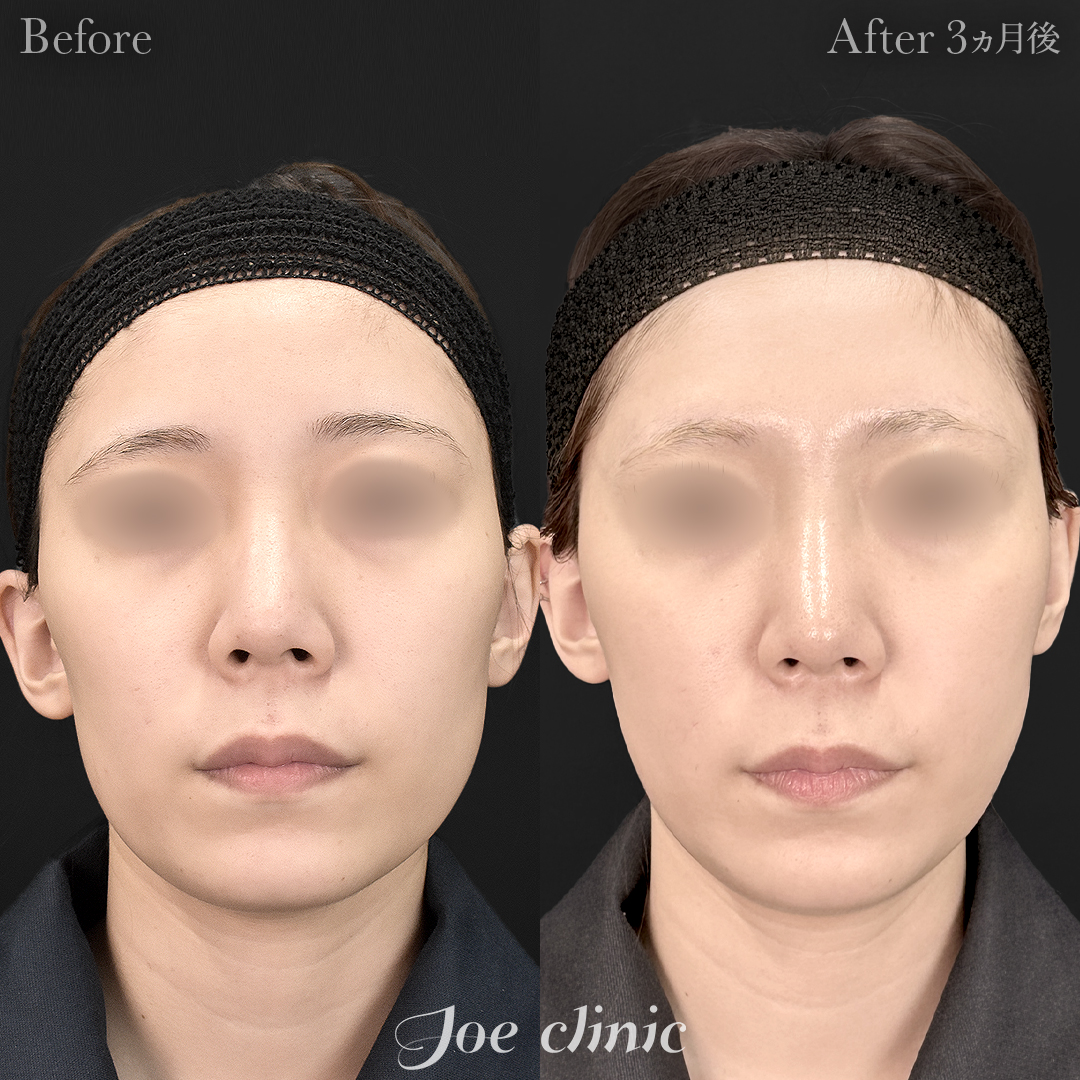 【20代女性】脂肪吸引(フェイスライン・二の腕・肩)+脂肪注入(頬)|3ヵ月後