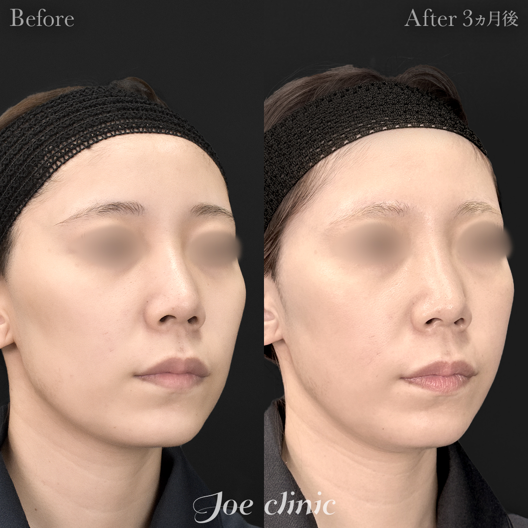 【20代女性】脂肪吸引(フェイスライン・二の腕・肩)+脂肪注入(頬)|3ヵ月後