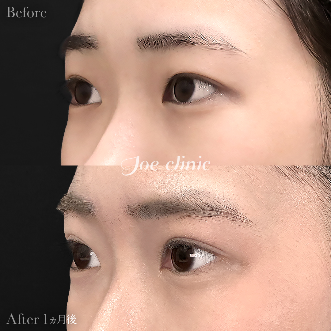 【10代女性】ジョウクリ式二重埋没法3点留め|1ヵ月後