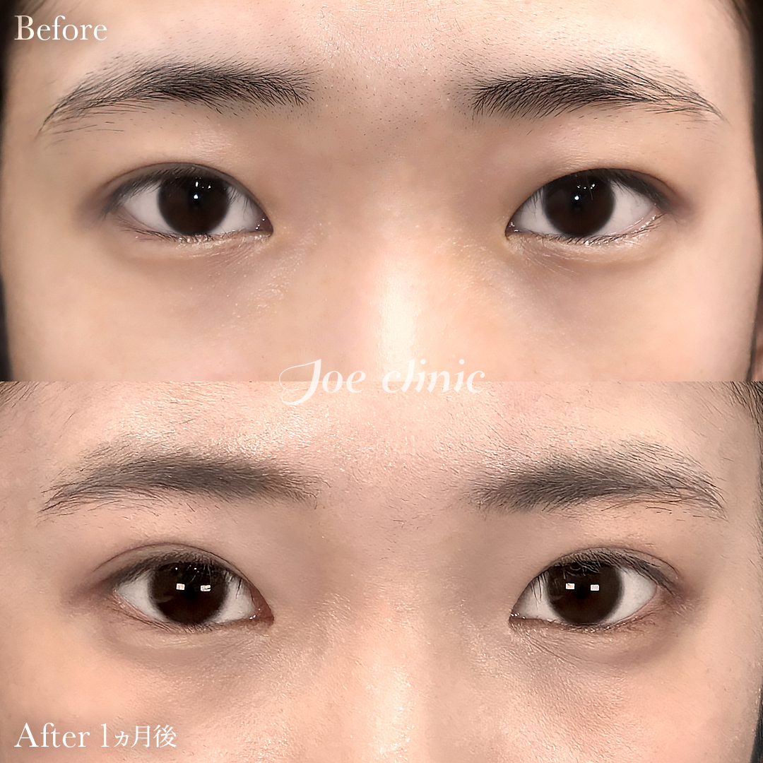 【10代女性】ジョウクリ式二重埋没法3点留め｜1ヵ月後