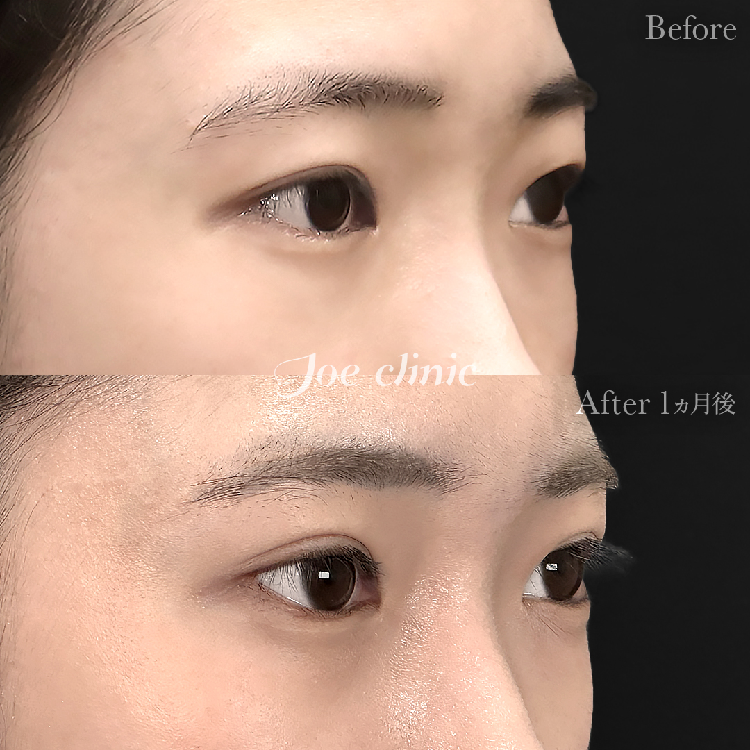 【10代女性】ジョウクリ式二重埋没法3点留め|1ヵ月後