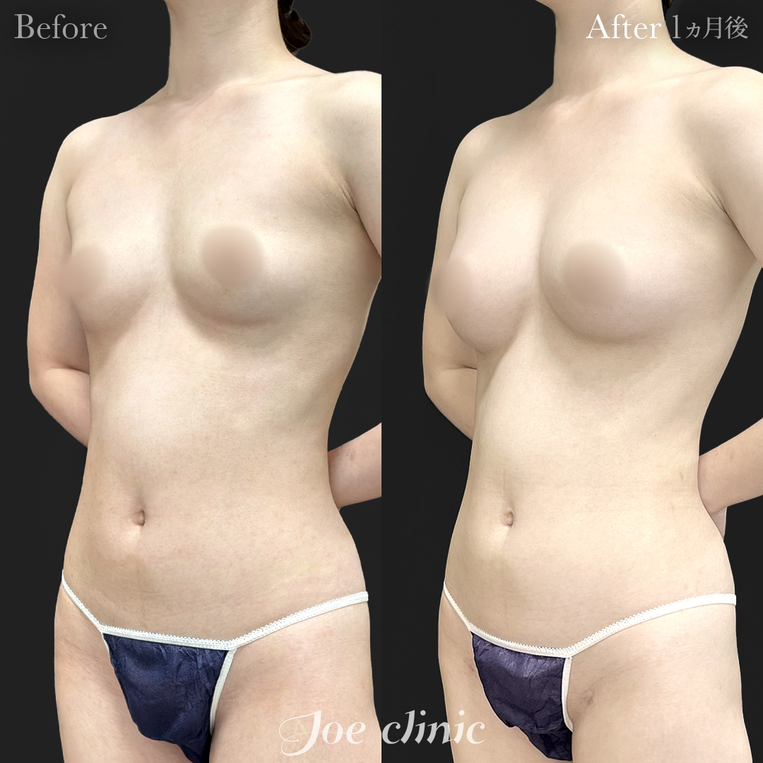 【20代女性】脂肪幹細胞注入豊胸(300cc×左右)|1ヵ月後