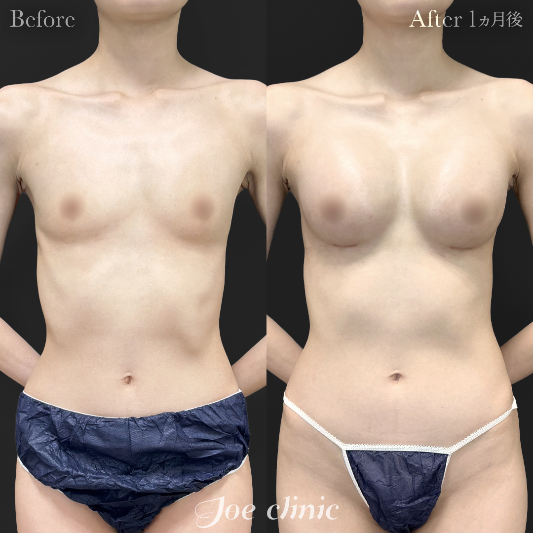 【20代女性】シリコンバッグ豊胸モティバ2(290cc×左右) 胸下切開 デュアルプレーン法|1ヵ月後