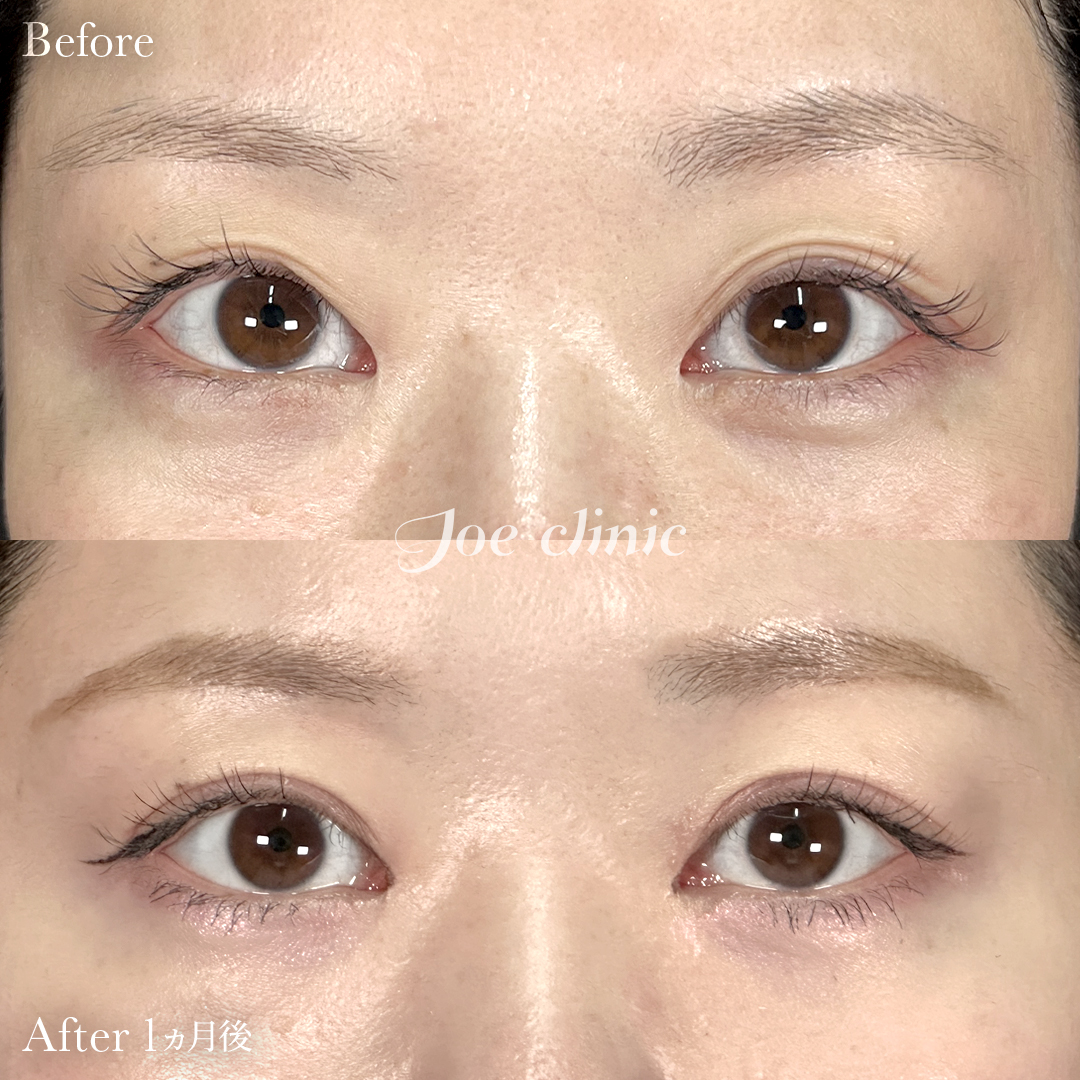 【30代女性】ジョウクリ式二重埋没法2点留め|1ヵ月後