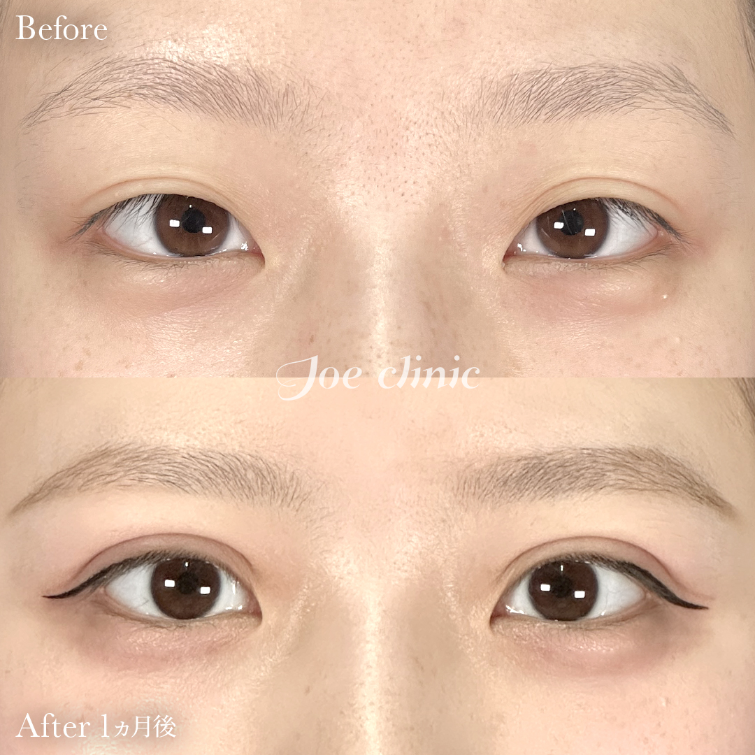 【20代女性】ジョウクリ式二重埋没法3点留め+脂肪取り術|1ヵ月後