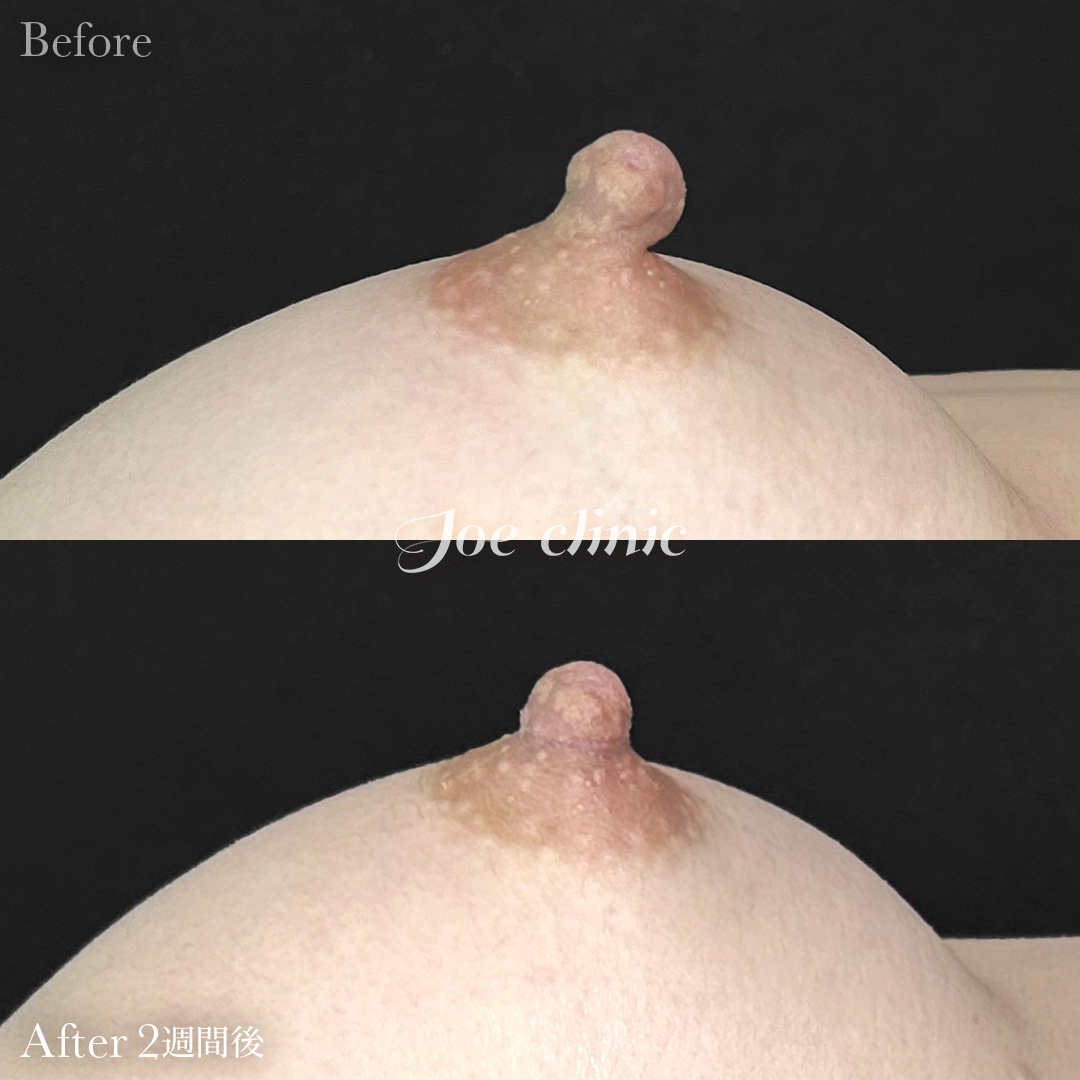【20代女性】乳頭縮小術|2週間後