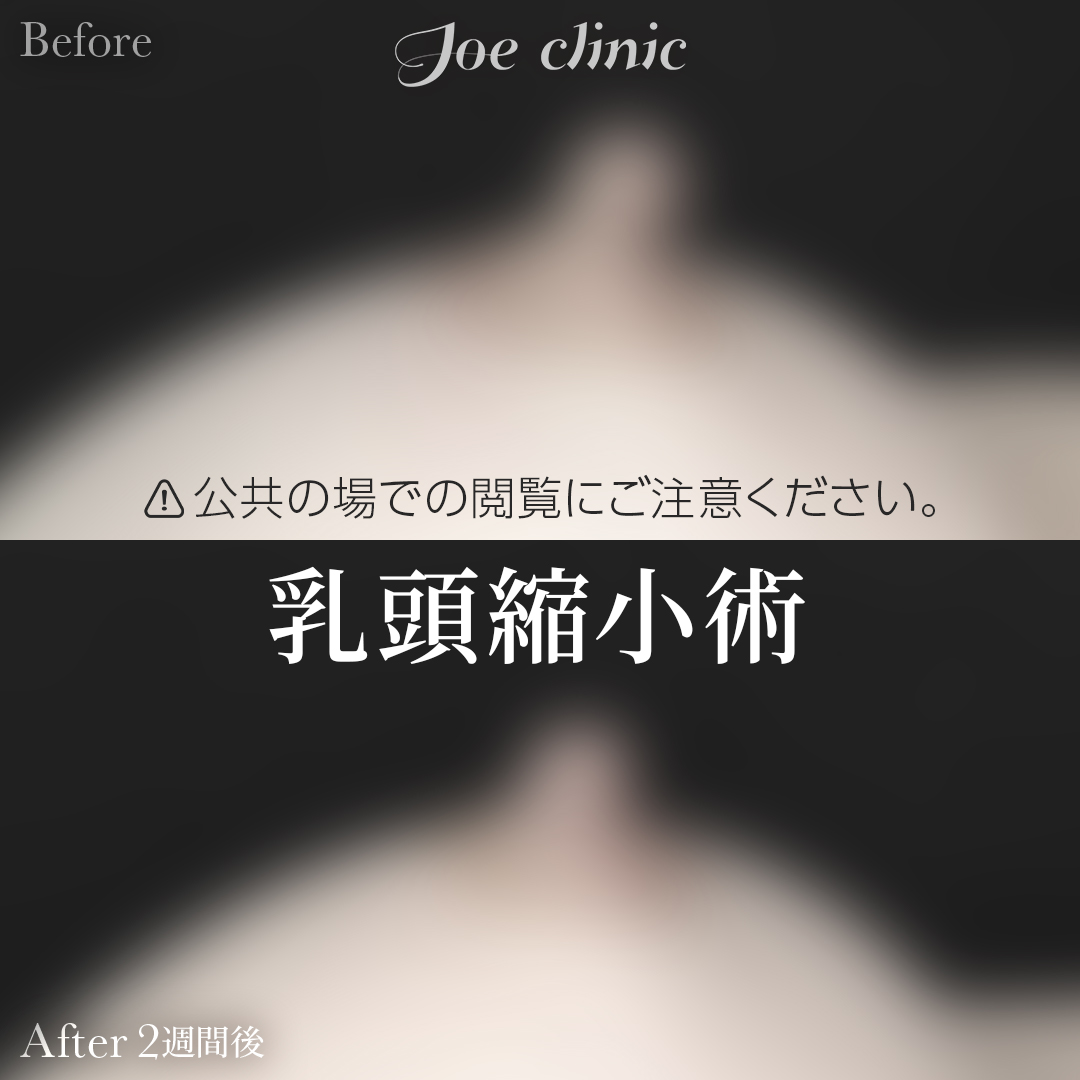 【20代女性】乳頭縮小術｜2週間後