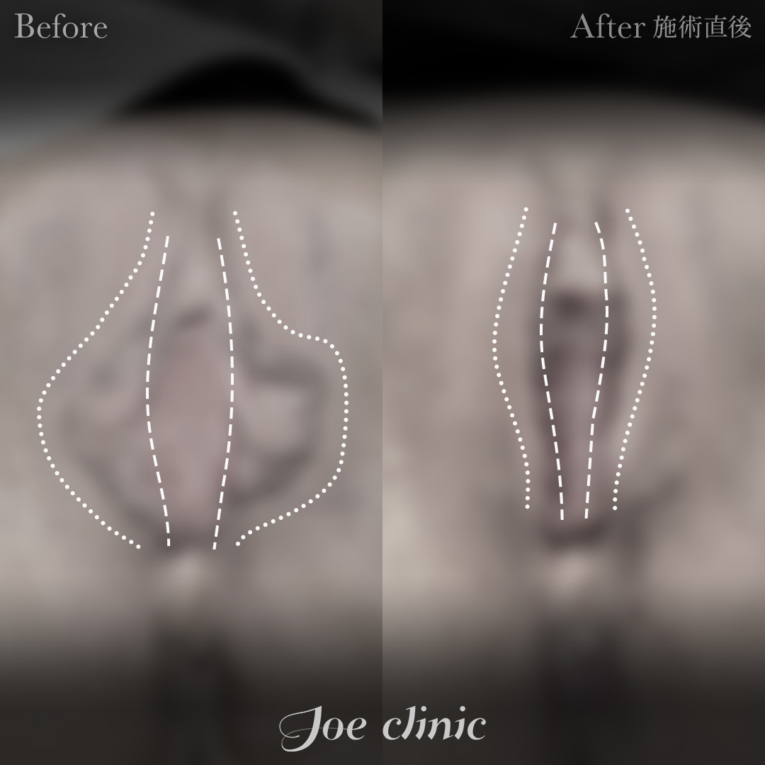 【40代女性】小陰唇縮小術＋副皮除去術｜施術直後