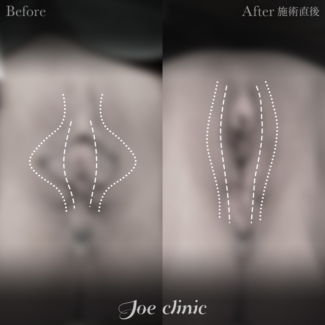 【50代女性】小陰唇縮小術＋副皮除去術｜施術直後