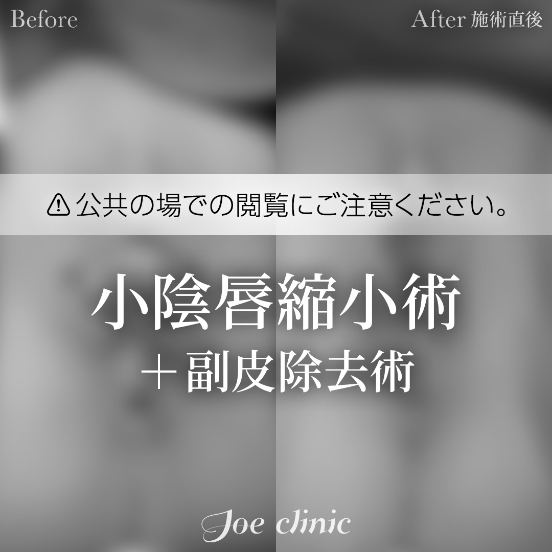 【50代女性】小陰唇縮小術＋副皮除去術｜施術直後