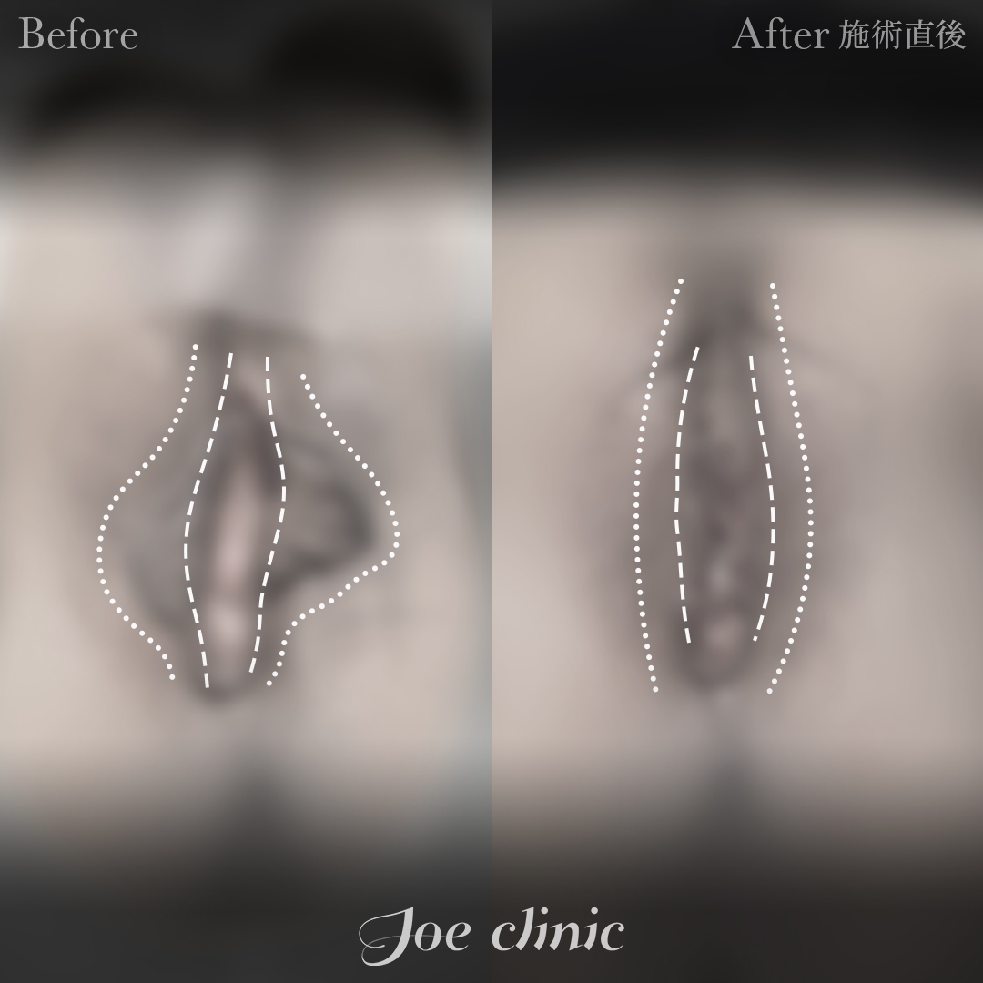 【30代女性】小陰唇縮小術|施術直後