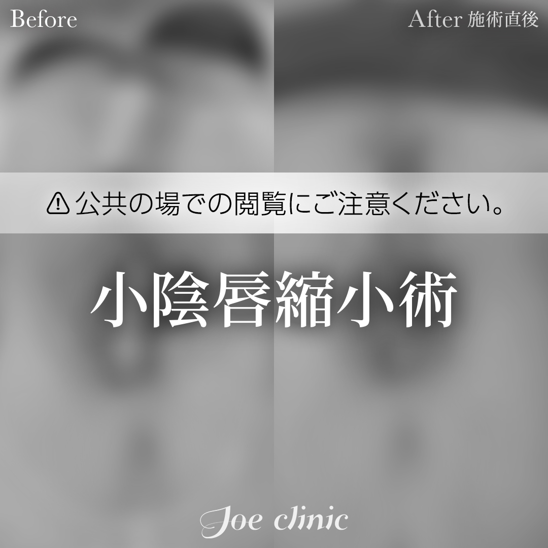 【30代女性】小陰唇縮小術｜施術直後