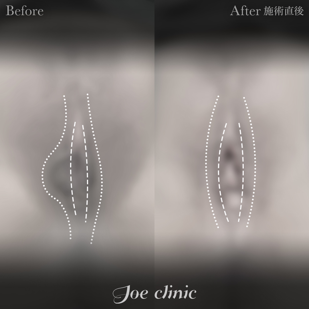 【30代女性】小陰唇縮小術|施術直後