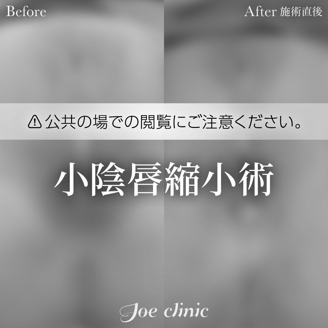 【30代女性】小陰唇縮小術｜施術直後