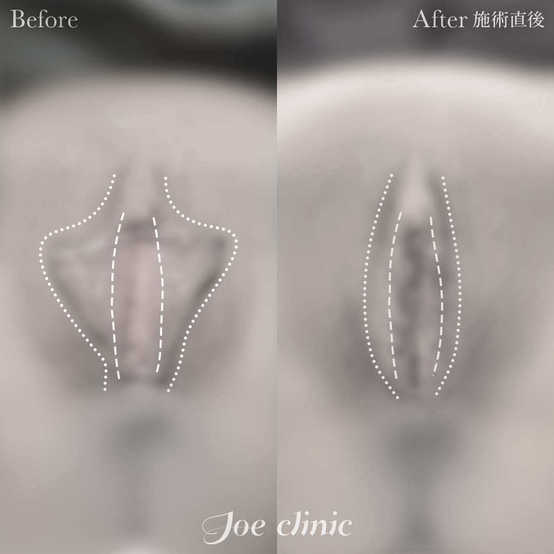 【50代女性】小陰唇縮小術|施術直後