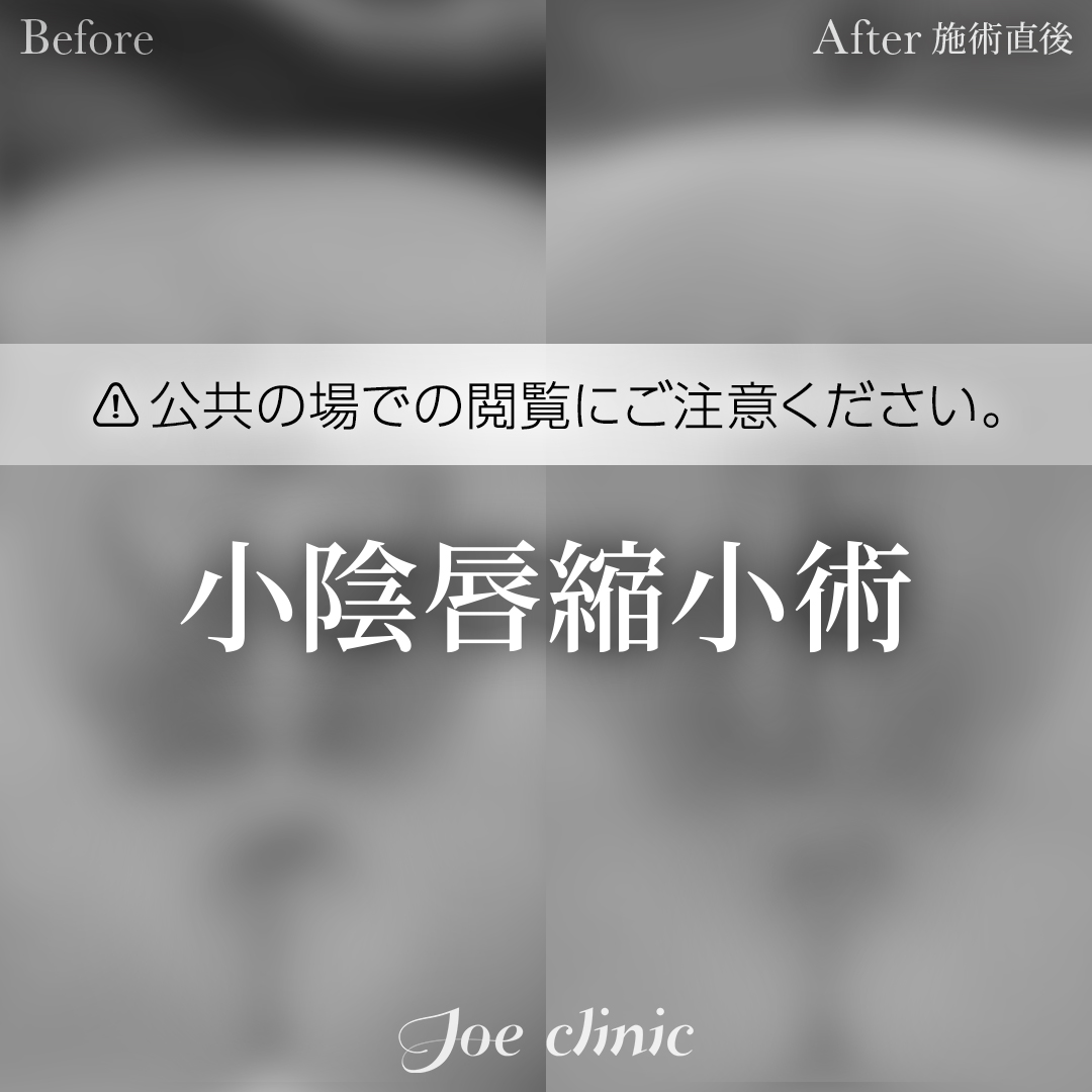 【50代女性】小陰唇縮小術｜施術直後
