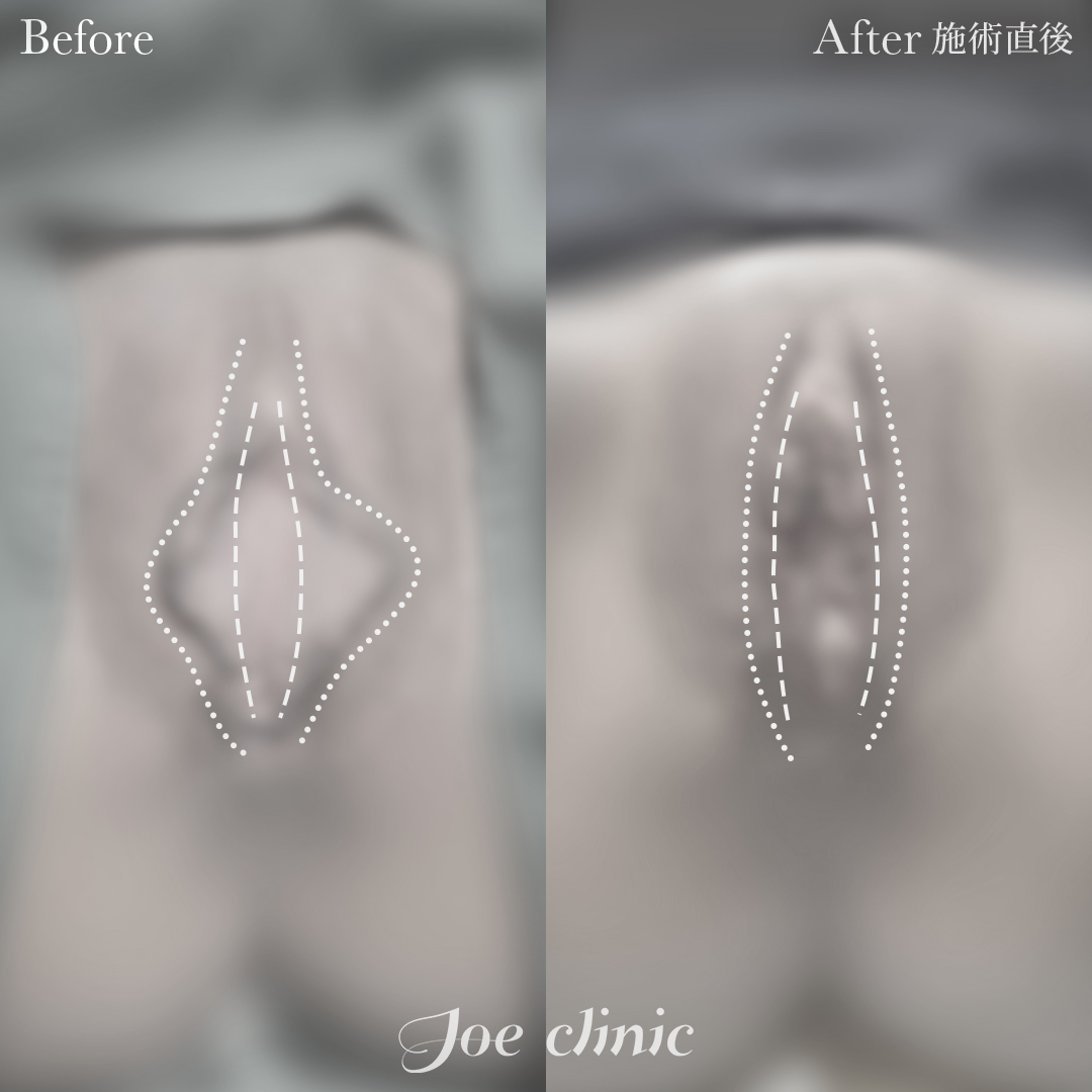 【40代女性】小陰唇縮小術＋副皮除去術｜施術直後