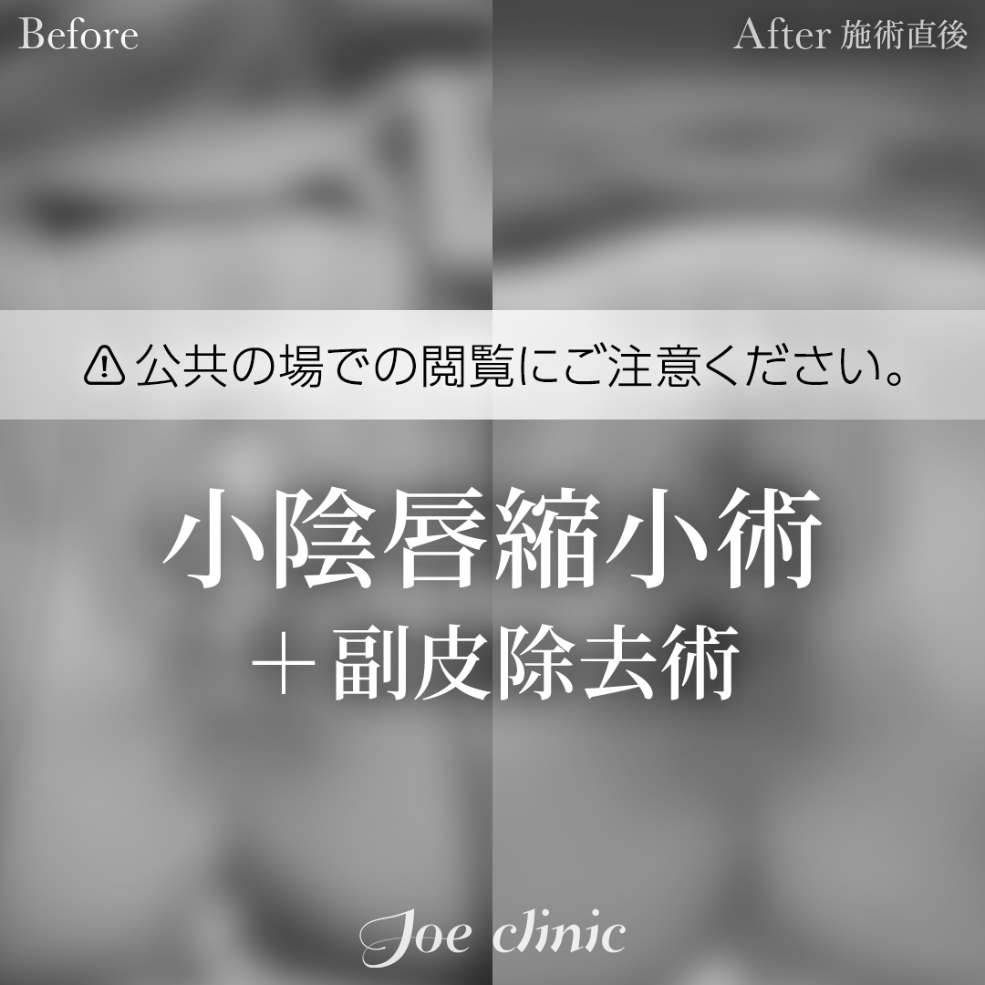 【40代女性】小陰唇縮小術＋副皮除去術｜施術直後